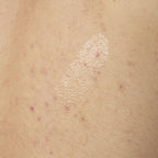 Close-up texture shot of The Ordinary Salicylic Acid 0.5% Body Serum. The clear, lightweight gel is shown applied directly to skin with some visible body acne, demonstrating its consistency.